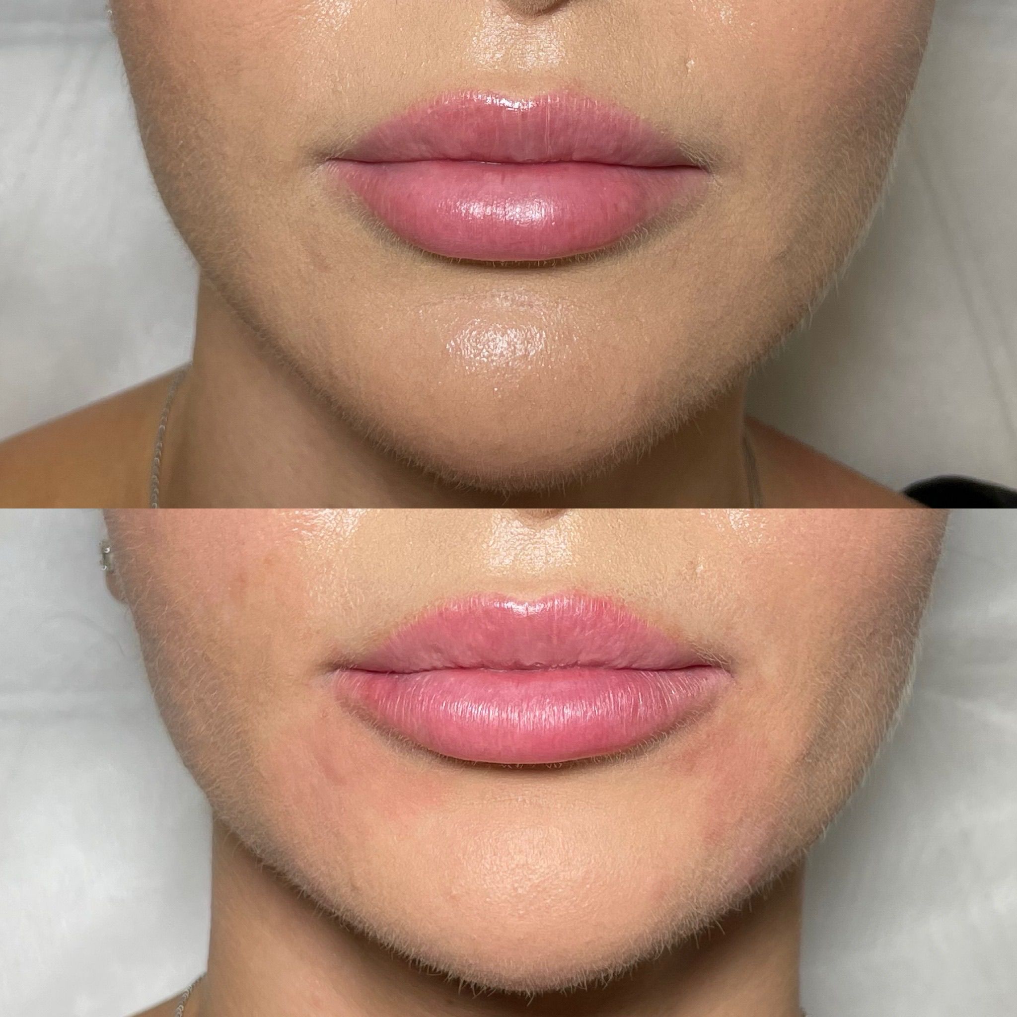 Lip Filler London: Elevated Lip Enhancement & Modern Lip Augmentation