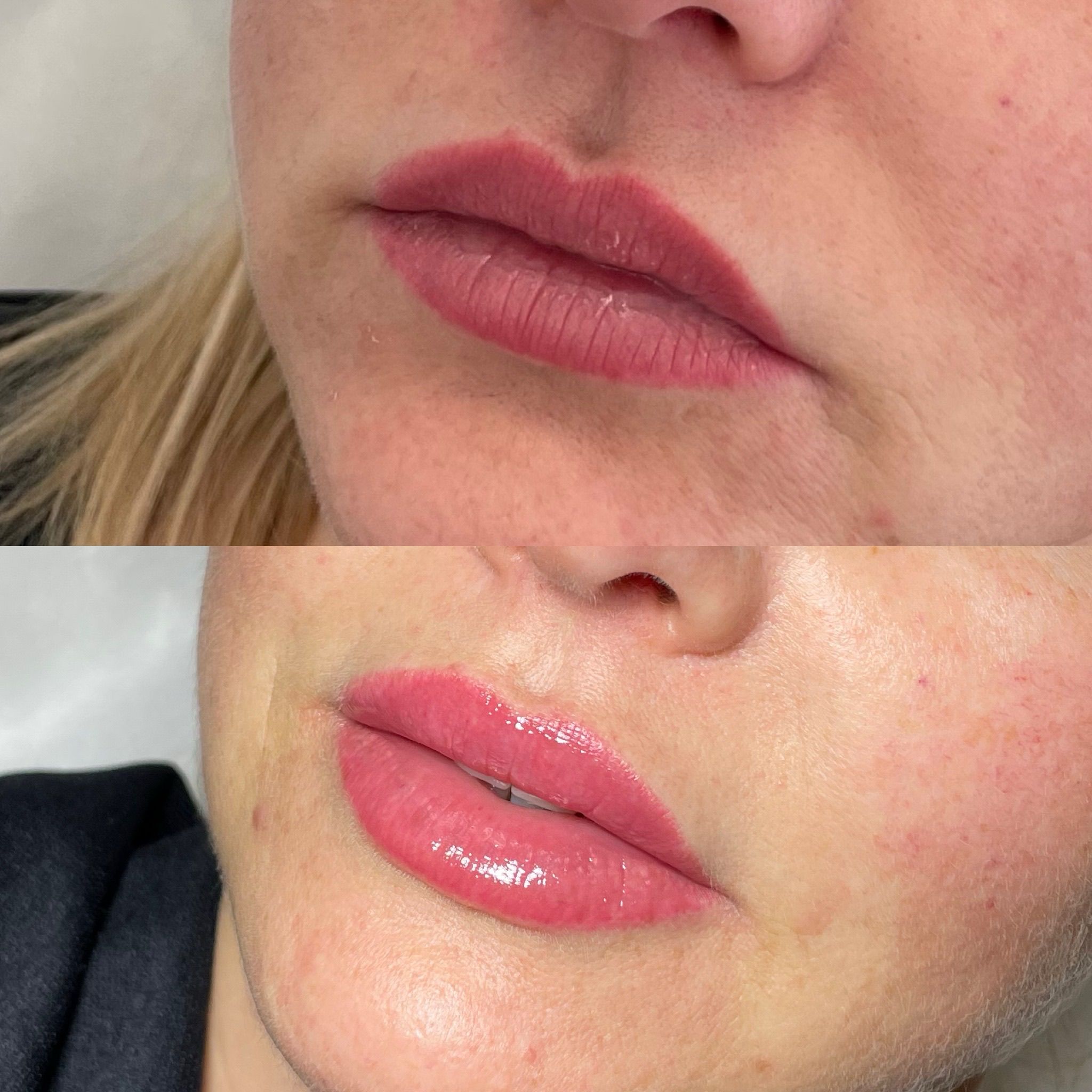 Lip Filler London: Elevated Lip Enhancement & Modern Lip Augmentation